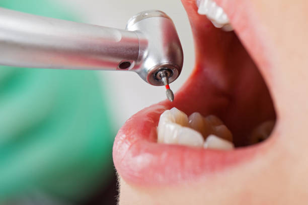 Best Emergency Treatment for Dental Infections or Abscesses in Broadview, IL